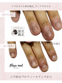 ティアラネイル 宇都宮/リプロネイル深爪矯正コース