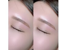 ミニョン(mignon)/スレッティング(お顔脱毛)