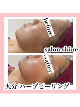 サロンシャイン(Salon Shine)/ハーブピーリング２回。