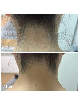 エース(ACE.)/うなじ脱毛☆後ろ姿美人