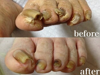 ドクターネイル爪革命 札幌本店/症例紹介 1 肥厚爪