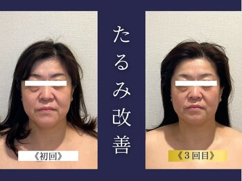 エレミュー 烏丸(Elemue.)/50代　たるみ改善