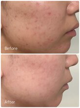 ククル(KUKULU)/陶肌ピール7回目♪(20代女性)