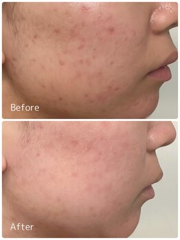 ククル(KUKULU)/陶肌ピール7回目♪(20代女性)