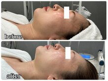 エミマス ボーテ(Emimas Beaute’)/４０代前半　毛穴洗浄＆幹細胞