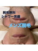 サロン アムール(salon Amour)/髭脱毛