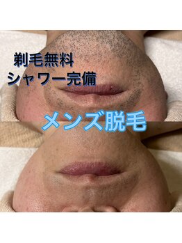 サロン アムール(salon Amour)/髭脱毛