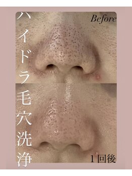 アールエム ボーテ(RM beaute')/ハイドラ毛穴洗浄!