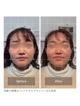 ルフレ 心斎橋(Reflet)/小顔矯正&毛穴洗浄　BeforeAfter