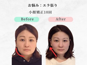 美容整体ウェリナ 名駅院/.【小顔矯正before→after】