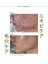 ミレラ(Mirela)/繰り返すニキビから卒業！