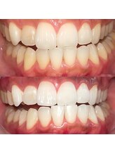 ラヴィス(RAVIS)/セルフホワイトニング