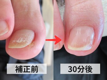 ルポ(REPOS)/陥入爪ケア