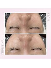 シャルムパリス(charme paris)/艶肌◎１回の施術変化