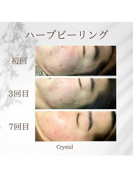 クリスタル(Crystal)/ハーブピーリング☆