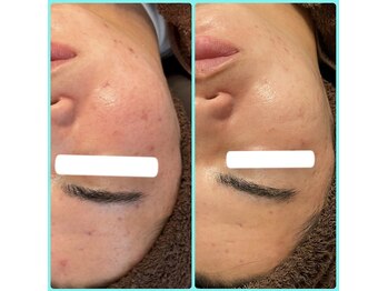 メリー 大和八木店(merry)/メンズ美容お悩みのあなたへ★