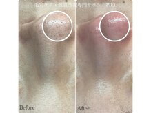 ピエル 北千住店(PIEL)/毛穴エクストラクション