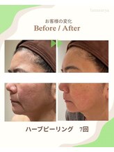 ルナスーリヤ 仙台店/ハーブピーリング