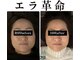 キュープ 浜松店(Qpu)の写真/【小顔矯正専門サロンの老舗】食いしばりによるあごの疲れやエラ張りを整え、シャープなフェイスラインに
