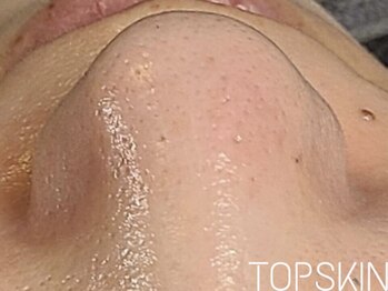 トップスキン 栄(TOPSKIN)/毛穴特化メニューあります♪