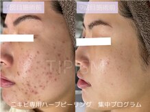 ハービー(Herbee)/肌荒れから卒業