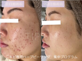 ハービー(Herbee)/肌荒れから卒業