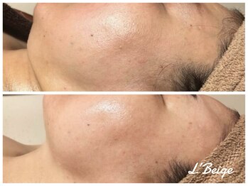 レ ベージュ(L’Beige)/リアボーテ肌質改善フェイシャル