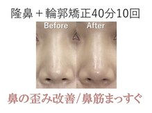 ラプリ 梅田店(Raplit)/隆鼻＋輪郭矯正40分10回