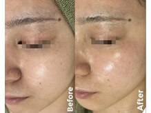 肌質改善専門【Salon da Mahina】毛穴ケア/ニキビケア/ハーブピーリング/艶肌/フェイスワックス/藤沢