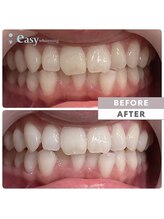 イージーホワイトニング 神戸三宮店(easy whitening)/お客様の症例写真です★