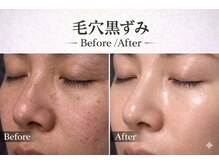 ワイズデュー(Y's Dew)/ハーブピーリング