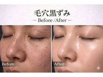 ワイズデュー(Y's Dew)/ハーブピーリング