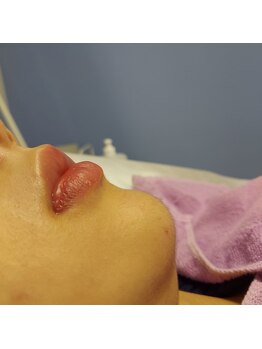 キアラ 麻布十番(Kiara)/顔脱毛　ブラジリアンワックス