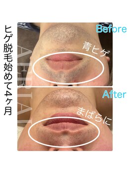 エアリアル 武雄店/ヒゲ脱毛