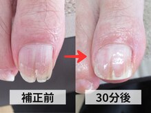 ルポ(REPOS)/割れ爪ケア