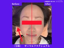 フェレザ 新潟(Felleza)/サーマルフラクショナル