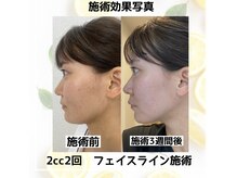 アニー(Annie)の雰囲気（レモンボトル1回効果写真）