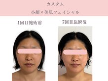 カスタム　小顔×美肌フェイシャル