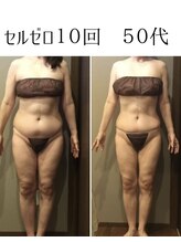 ムーン 高崎店(MOON)/セルゼロ痩身3ヶ月