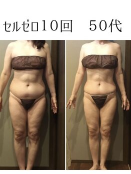ムーン 高崎店(MOON)/セルゼロ痩身3ヶ月