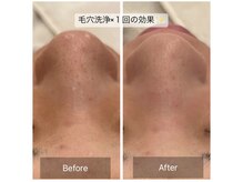 ハニー(Honey)/毛穴の開き気になる方