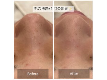 ハニー(Honey)/毛穴の開き気になる方