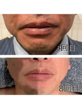 レイモード(Ray mode)/ヒゲ脱毛