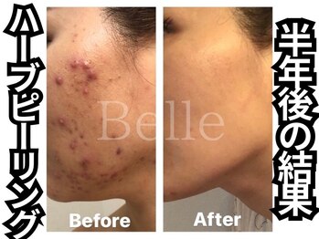 ベル 南船場店(Belle)/ニキビケア毛穴ケア