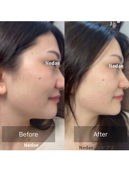 アートデポット ネドアエ(Art depot Nedae)/小顔矯正整顔 before&after