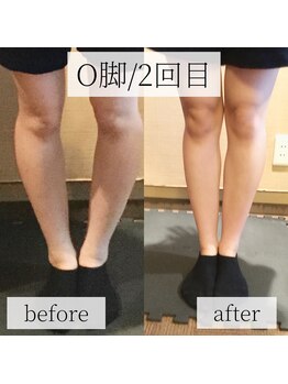 ミーツ(MEETS)/O脚でお悩みの20代女性/2回目