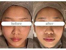 リスタ(RSTA)/【BEFORE/AFTER】