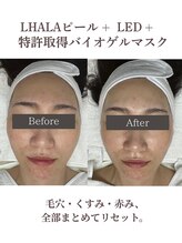 フォルディオ(FORDIO)/ララピールxバイオゲルxLED