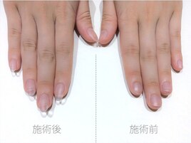 クリア/深爪解消/理想の長さ実現