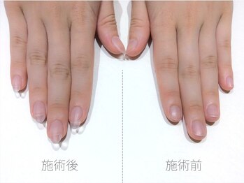 クリア/深爪解消/理想の長さ実現